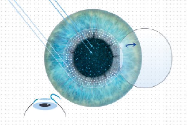 FEMTOSECOND LASIK